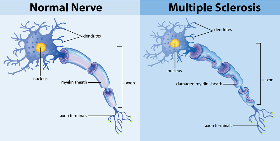 Diagram of normal nerve versus MS-stricken nerve